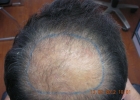 Before hair transplant -crown area