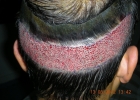 2023 FUE grafts extraction in one day