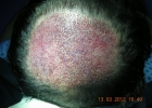 Crown Area hair transplantation in Pakistan