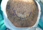 2nd-day-procedure