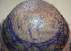 crown-area-hair-restoration