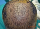 day-1-after-hair-transplant