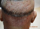 donor-area-after-fue