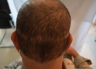 donor-area-scar-with-strip-ht