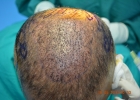 mid-scalp-hair-transplant-pakistan