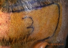 right-sided-fue