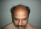 Hair Transplant before picture NW class 6