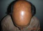 Norwood Class 6 male pattern baldness