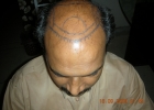 Hairline design and marking 