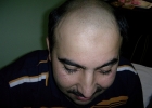 Before hair transplant NW 6