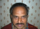 Hair Transplant result in Pakistan