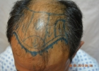 fue-hair-lahore