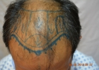 hair-loss-lahore