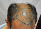 hair-restoration-lahore
