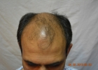 hair-transplant-lahore