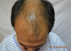 lahore-hair-transplant