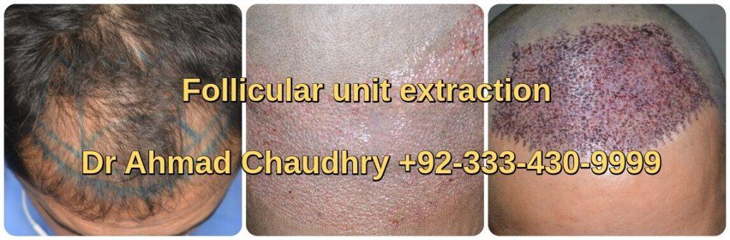 Follicular unit extraction hair transplant Pakistan