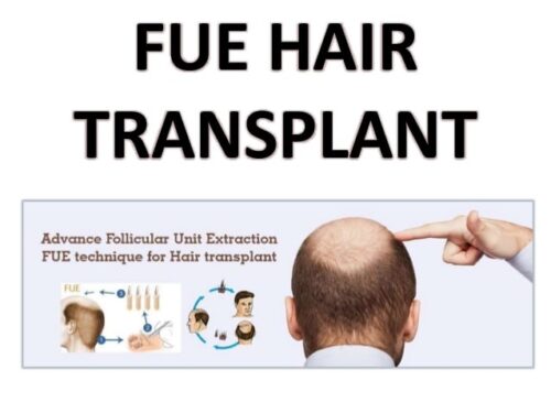 Follicular unit extraction hair transplant