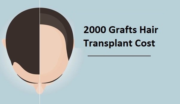 Hair transplant 2000 grafts cost Pakistan