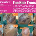 Hair Transplant in Pakistan-2