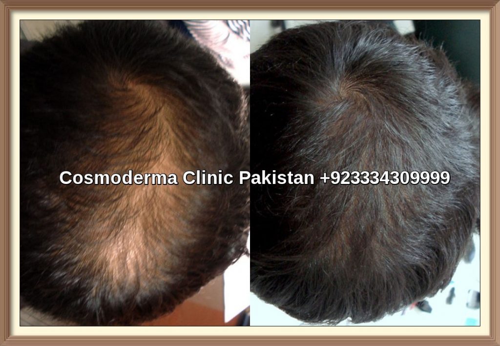 Pictures gallery hair transplant Lahore Pakistan FUTFUE