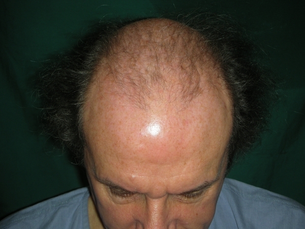 male pattern baldness UK patient 