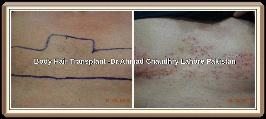 Body-hair-transplant-in-Pakistan-Dr-Ahmad-Chaudhry