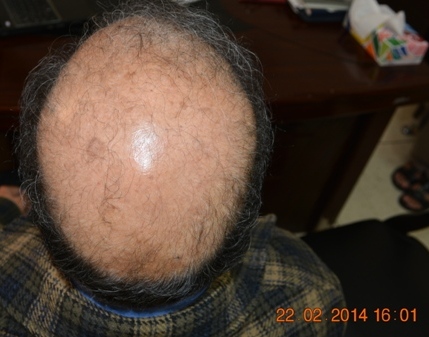 Candidate-hair-transplant-surgery