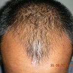 Front hair thinning before filling