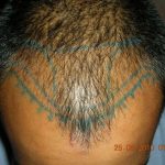 First session hair transplant area