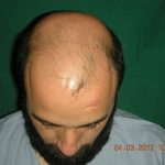 Complete baldness treatment