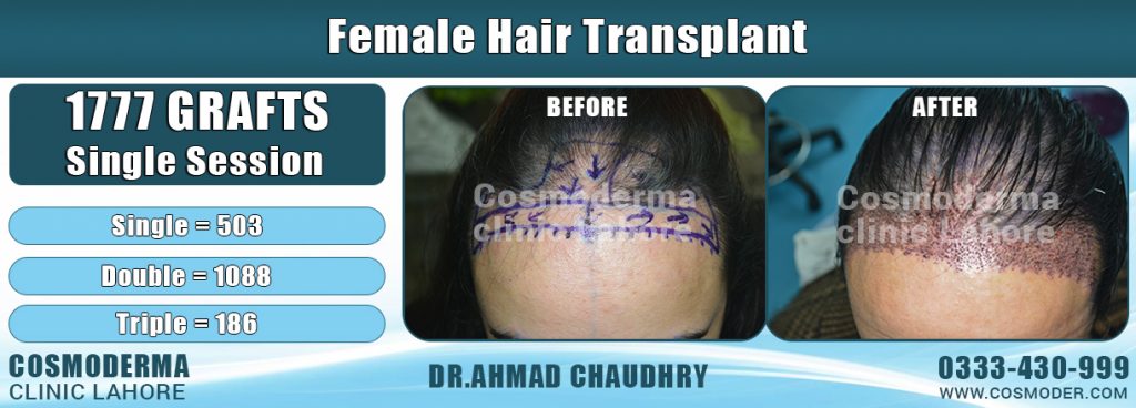 Female-hair-transplant-Lahore