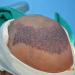 Follicular-unit-extraction-Lahore