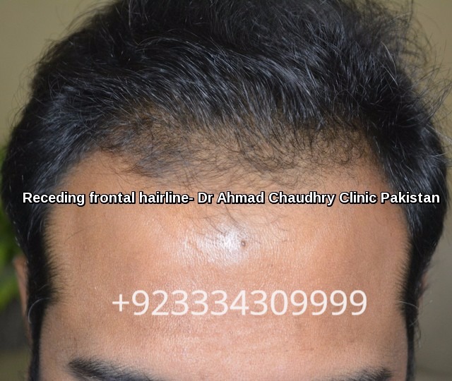 Front-hairline-receding-treatment-Japan