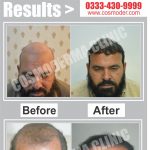 Frontal-hair-transplant-in-Lahore-Pakistan