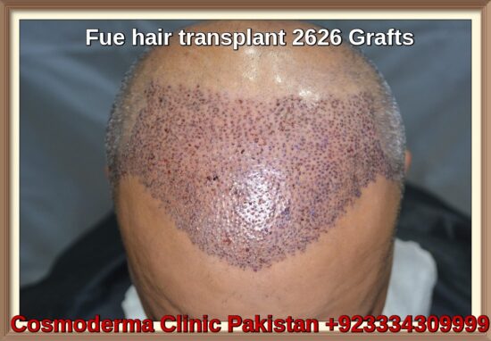 Fue-hair-transplant-2626-grafts-sharjah-patient