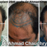 Fue hair transplant results Pakistan