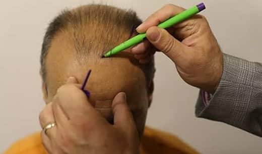 Front hairline designing in Pakistan