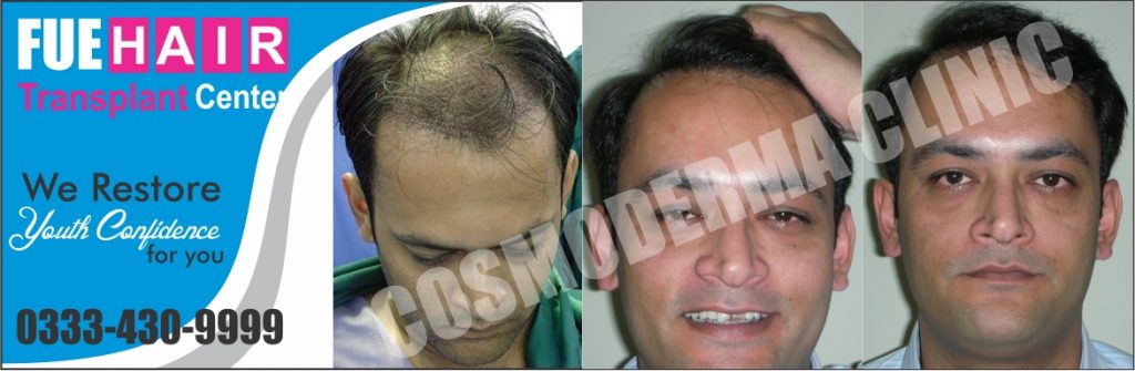 Hair transplant results in Pakistan