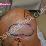 Left side donor area fue hair transplant