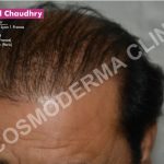 Poor hair growth in Lahore