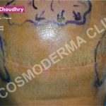 Previous strip surgery scar