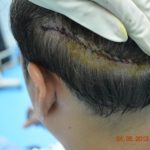 Will-hair-regrow-after-hair-transplant-on-donor-area