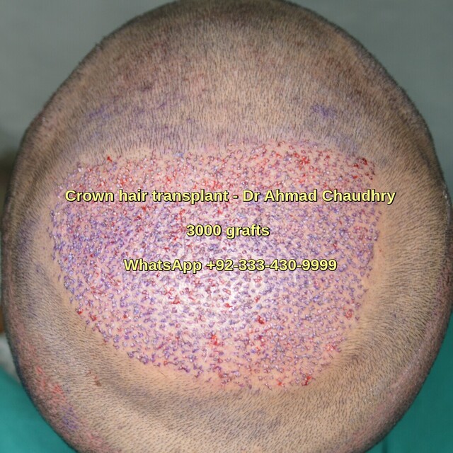 Crown hair transplant gallery in Lahore Pakistan See results
