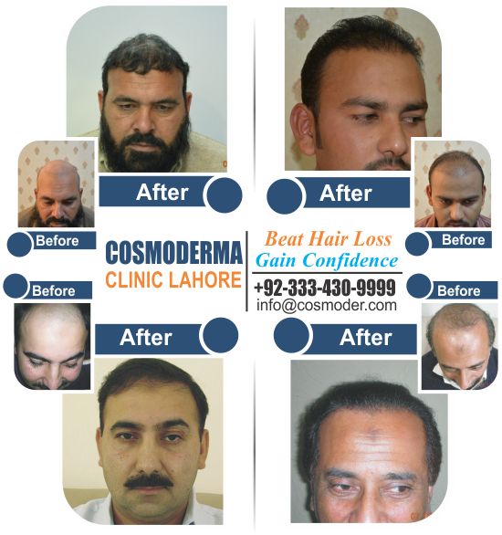 Hair transplant cost in Pakistan