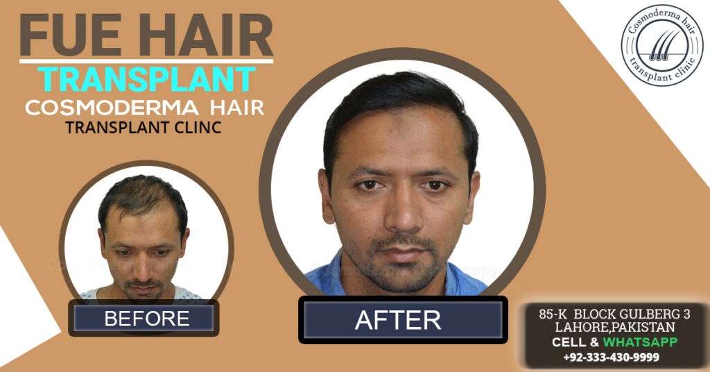 Hair transplant Fue Lahore