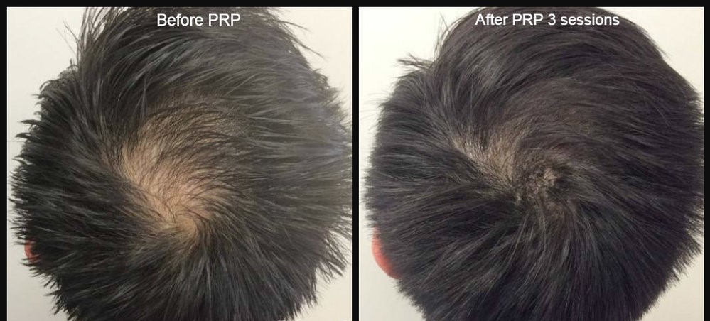 PRP hair treatment results Pakistan