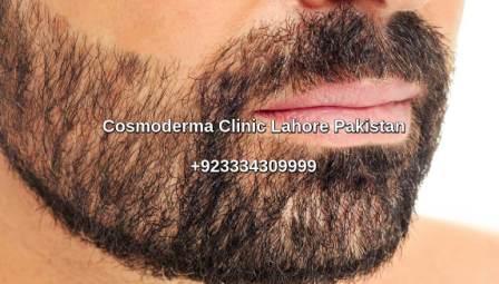 Beard hair transplant results Lahore Pakistan