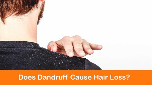 Read more about the article Does dandruff cause hair loss
