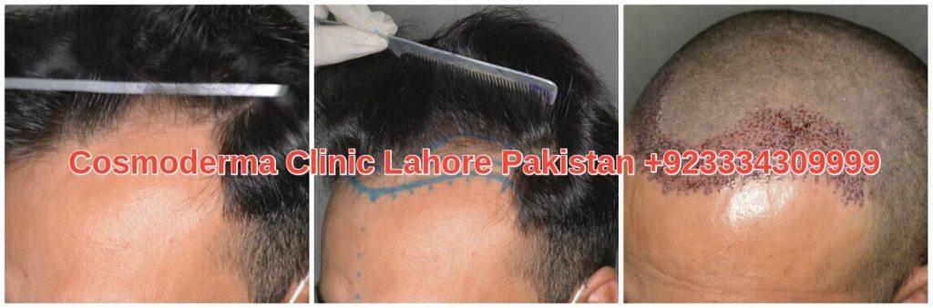 Hair transplantation Multan